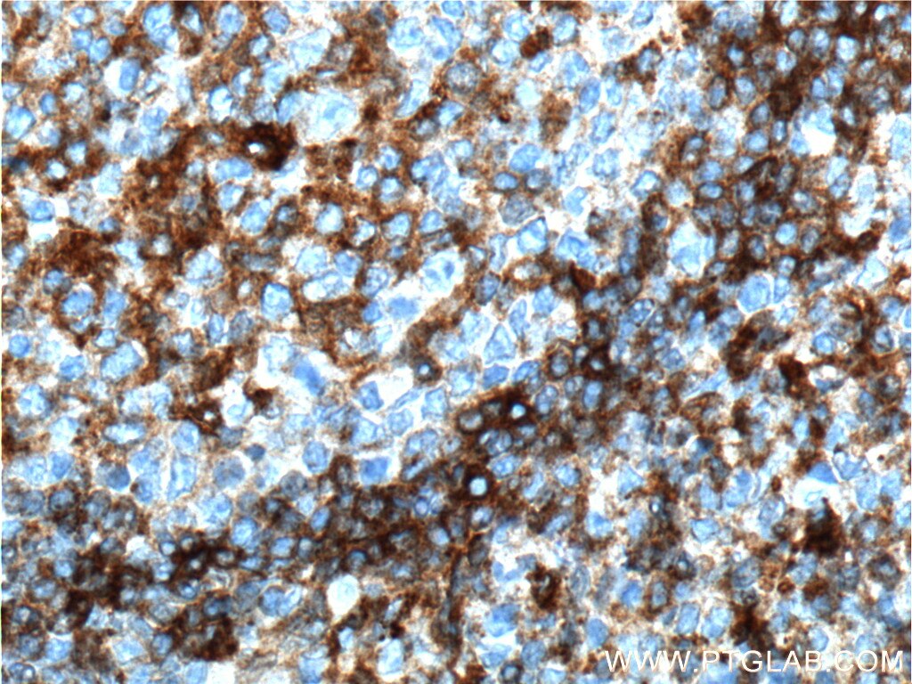 IHC staining of human tonsillitis using 16918-1-AP