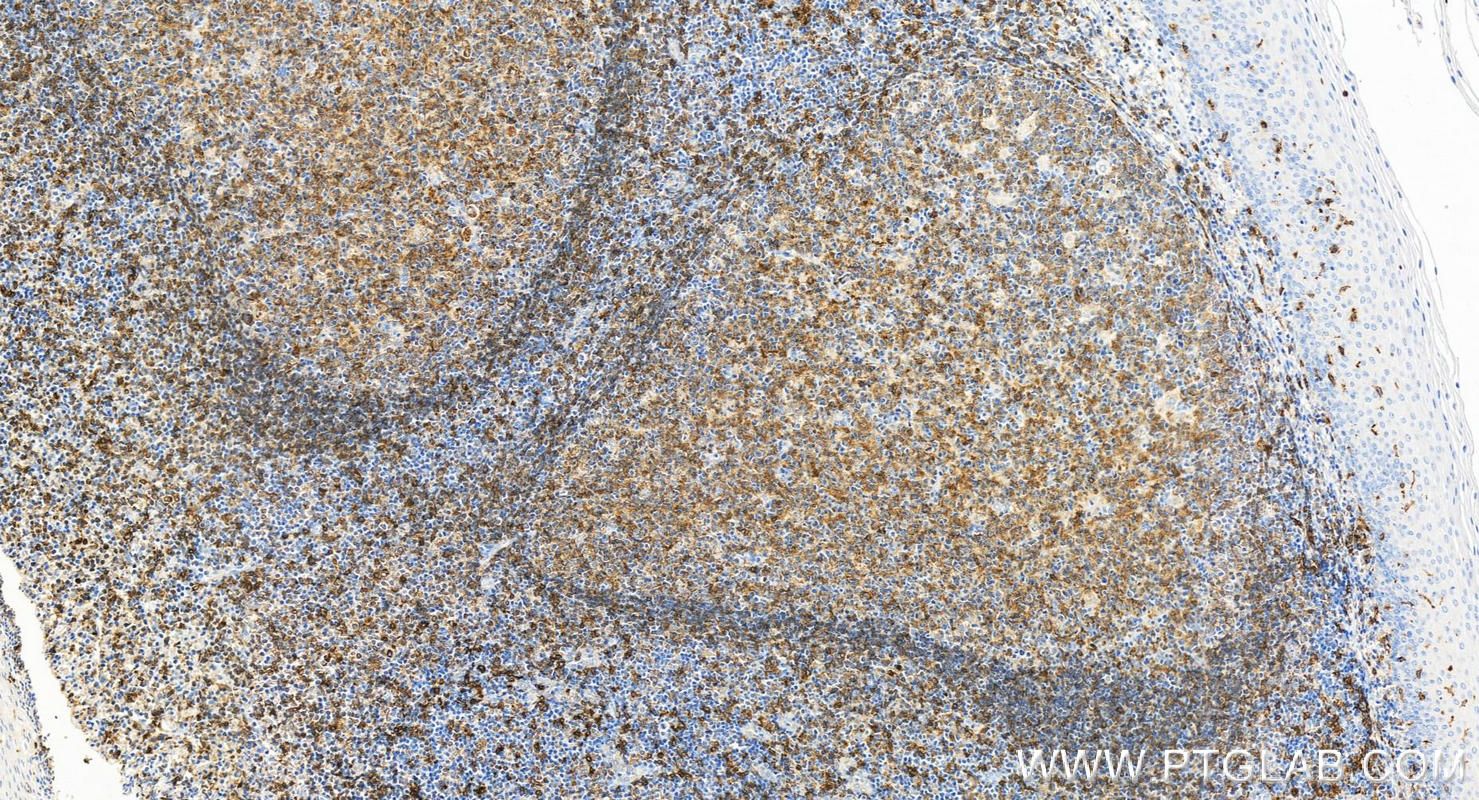Immunohistochemistry (IHC) staining of human tonsillitis tissue using HLA-DQB1 Polyclonal antibody (32281-1-AP)