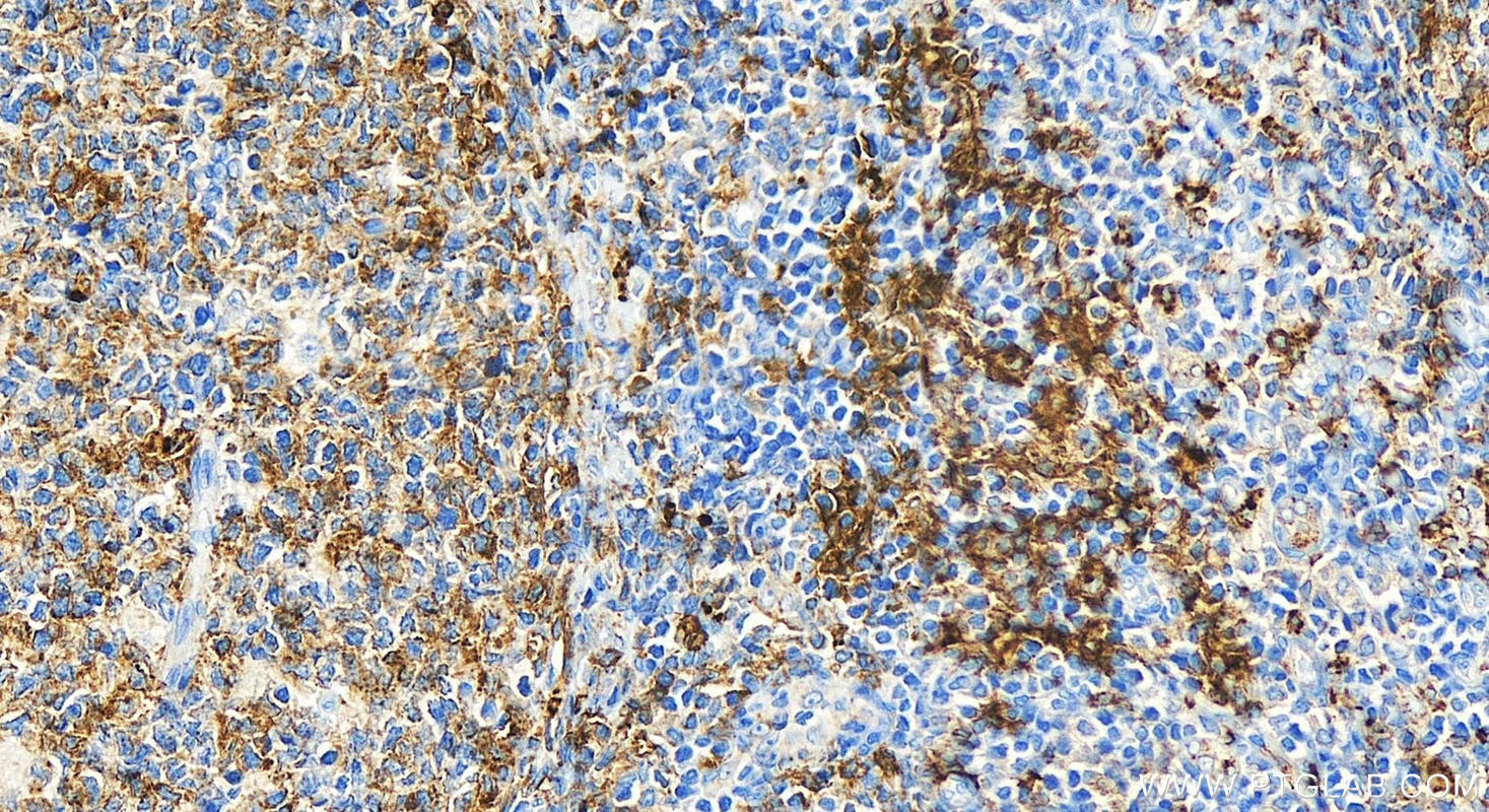 Immunohistochemistry (IHC) staining of human tonsillitis tissue using HLA-DQB1 Polyclonal antibody (32281-1-AP)