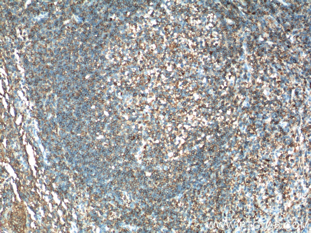 Immunohistochemistry (IHC) staining of human tonsillitis tissue using HLA-DRA Polyclonal antibody (17221-1-AP)