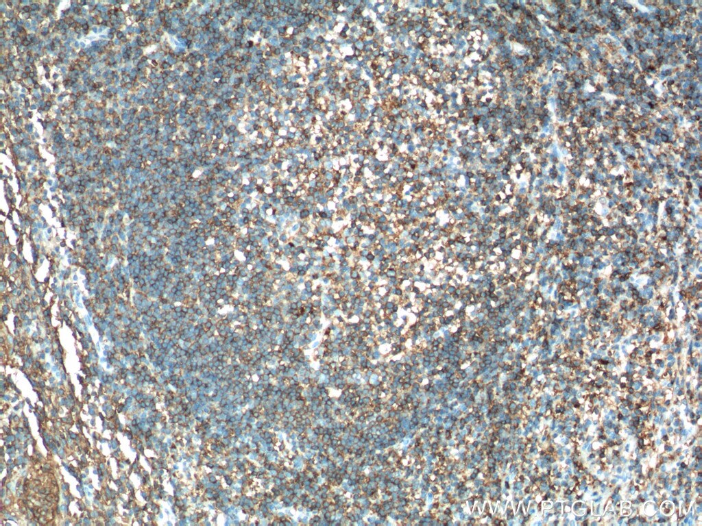 IHC staining of human tonsillitis using 17221-1-AP