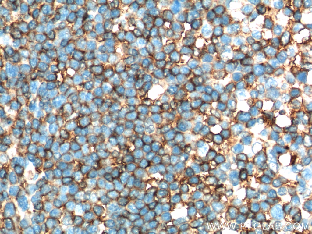 Immunohistochemistry (IHC) staining of human tonsillitis tissue using HLA-DRA Polyclonal antibody (17221-1-AP)