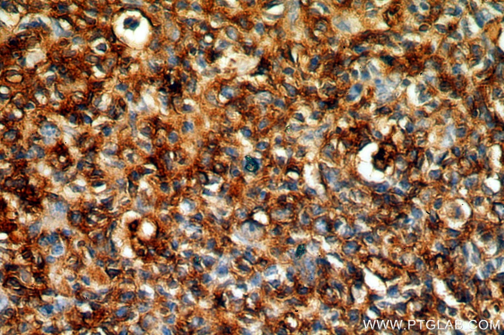 Immunohistochemistry (IHC) staining of human tonsil tissue using HLA-DRA Polyclonal antibody (17221-1-AP)