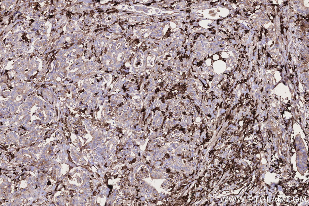 Immunohistochemistry (IHC) staining of human rectal cancer tissue using HLA-DRA Monoclonal antibody (68543-1-Ig)