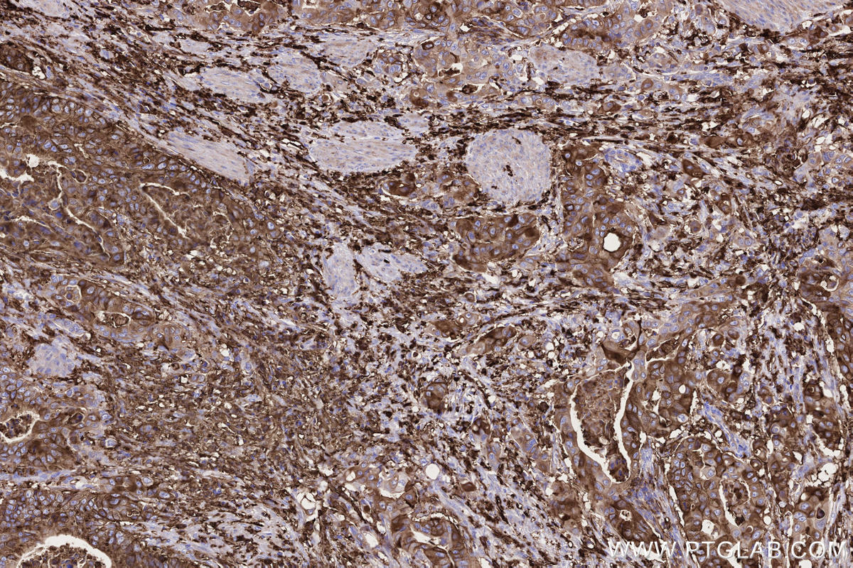 Immunohistochemistry (IHC) staining of human stomach cancer tissue using HLA-DRA Monoclonal antibody (68543-1-Ig)