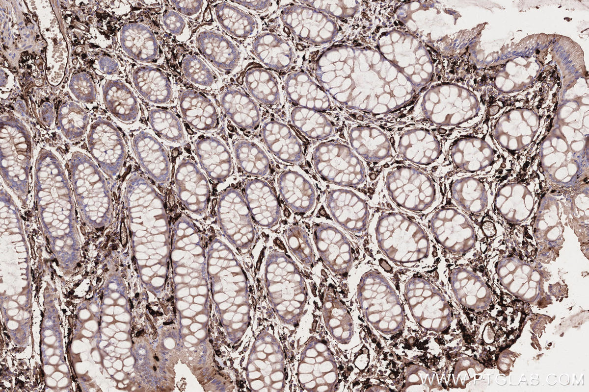 Immunohistochemistry (IHC) staining of human rectal cancer tissue using HLA-DRA Monoclonal antibody (68543-1-Ig)
