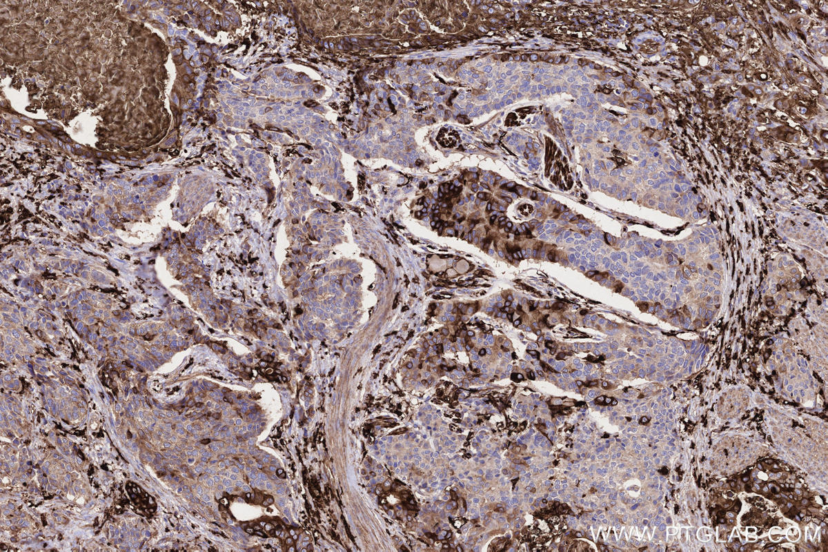 Immunohistochemistry (IHC) staining of human stomach cancer tissue using HLA-DRA Monoclonal antibody (68543-1-Ig)