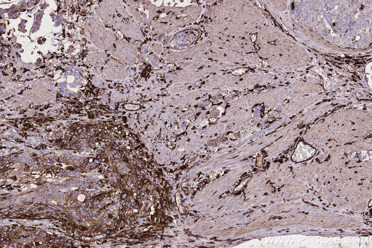 Immunohistochemistry (IHC) staining of human stomach cancer tissue using HLA-DRA Monoclonal antibody (68543-1-Ig)