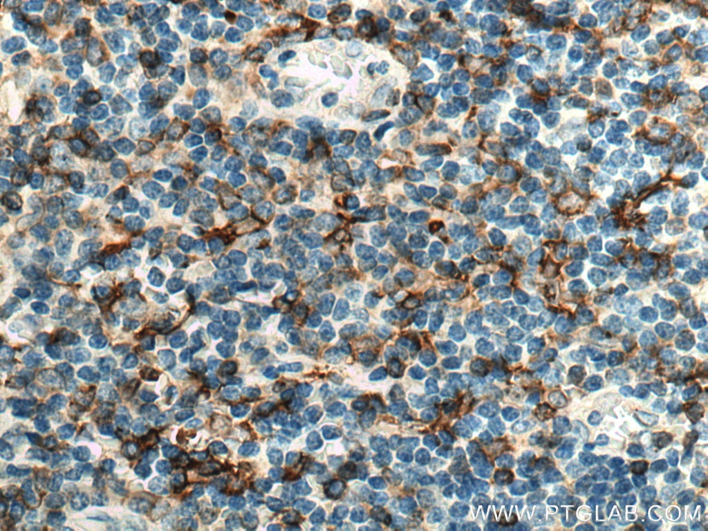 IHC staining of human tonsillitis using 15862-1-AP