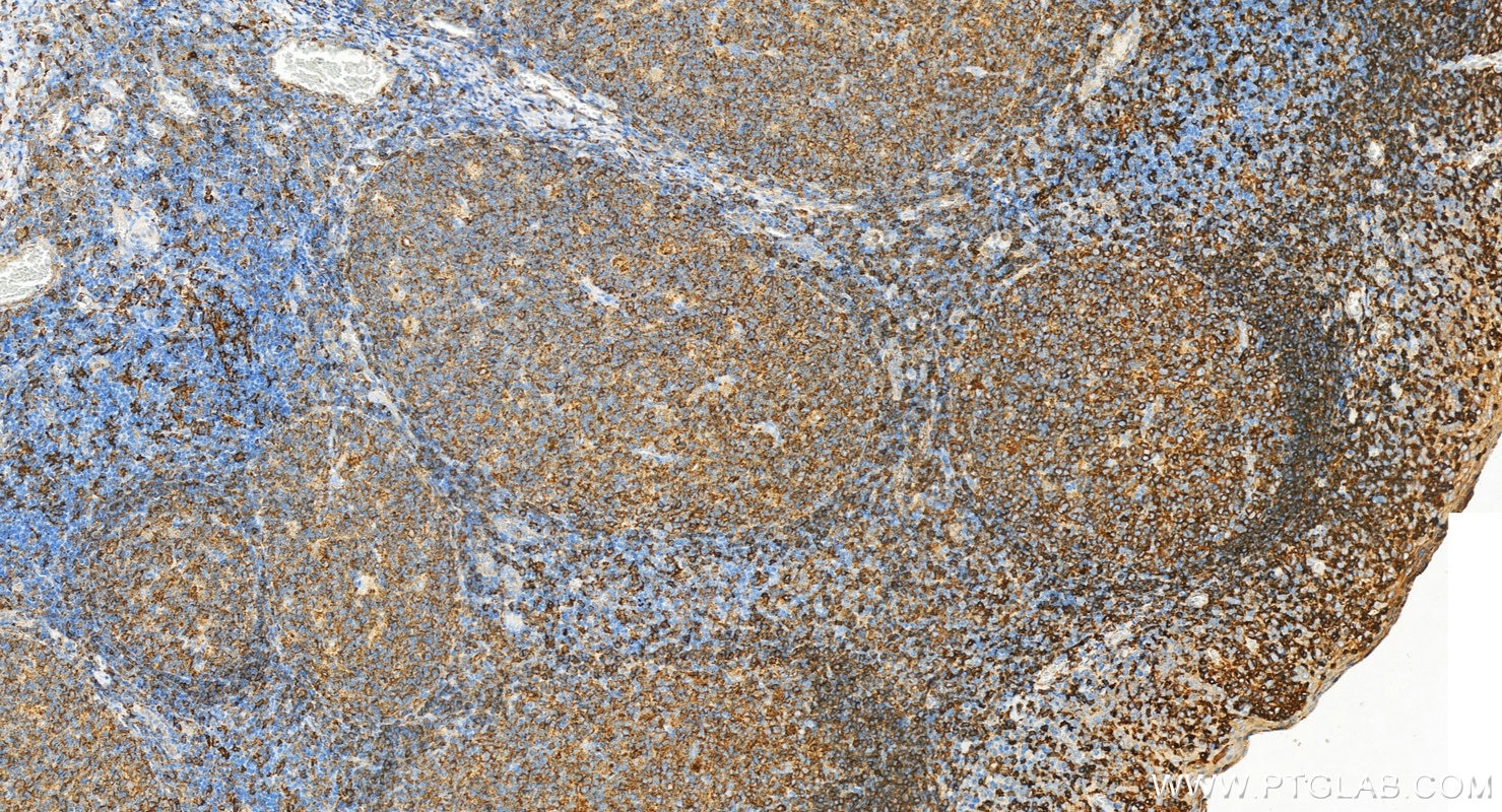 Immunohistochemistry (IHC) staining of human tonsillitis tissue using HLA-DRB4 Polyclonal antibody (15733-1-AP)