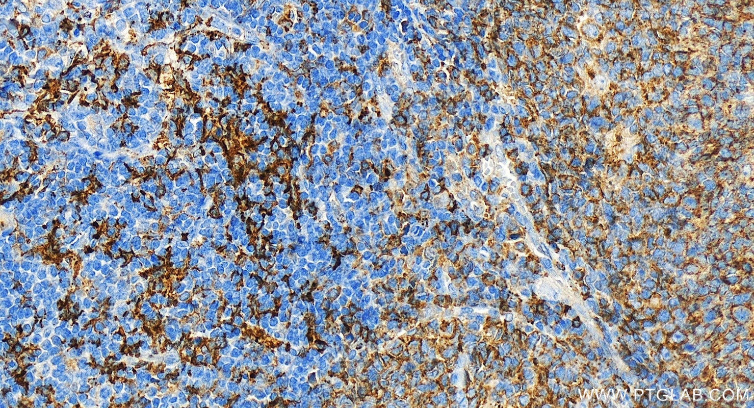 Immunohistochemistry (IHC) staining of human tonsillitis tissue using HLA-DRB4 Polyclonal antibody (15733-1-AP)