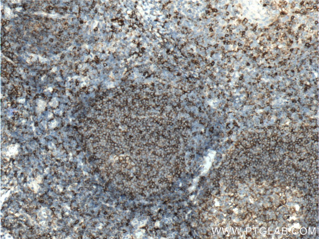 IHC staining of human tonsillitis using 21702-1-AP