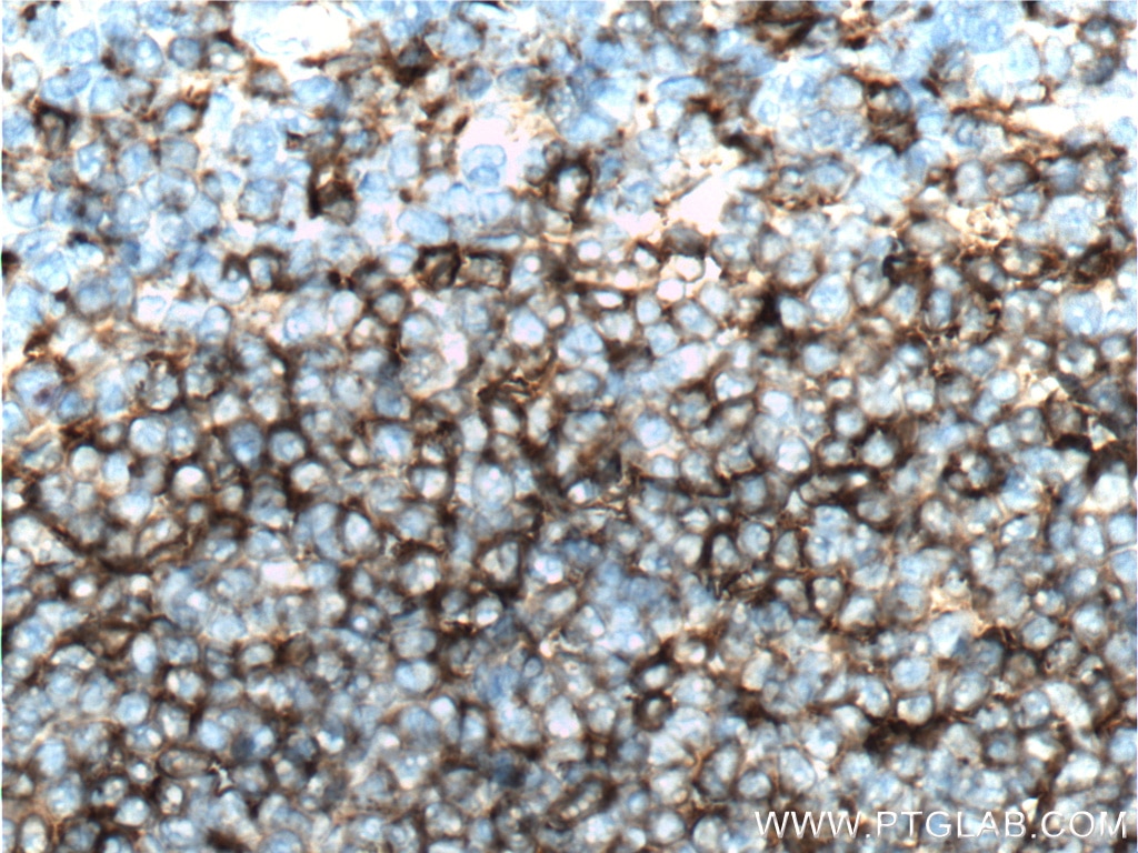 Immunohistochemistry (IHC) staining of human tonsillitis tissue using HLA-DRB5 Polyclonal antibody (21702-1-AP)