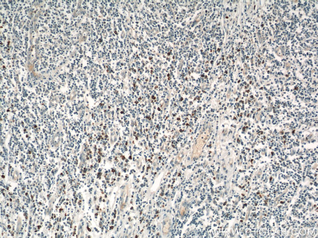 Immunohistochemistry (IHC) staining of human tonsillitis tissue using HLA-DRB5 Polyclonal antibody (21702-1-AP)