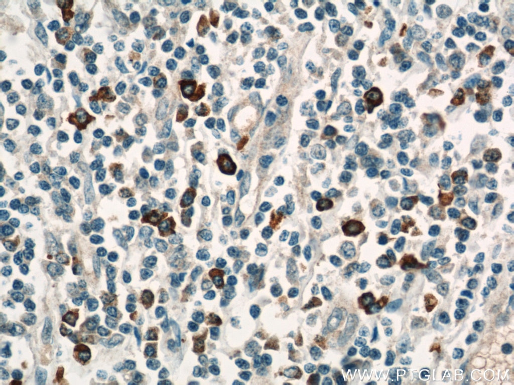 Immunohistochemistry (IHC) staining of human tonsillitis tissue using HLA-DRB5 Polyclonal antibody (21702-1-AP)