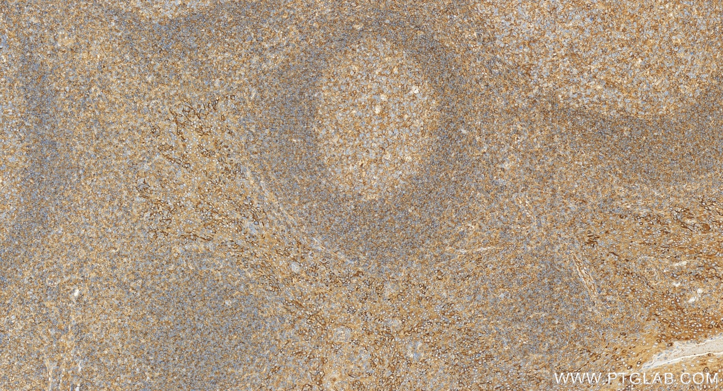 Immunohistochemistry (IHC) staining of human tonsillitis tissue using HLA-E Polyclonal antibody (27411-1-AP)