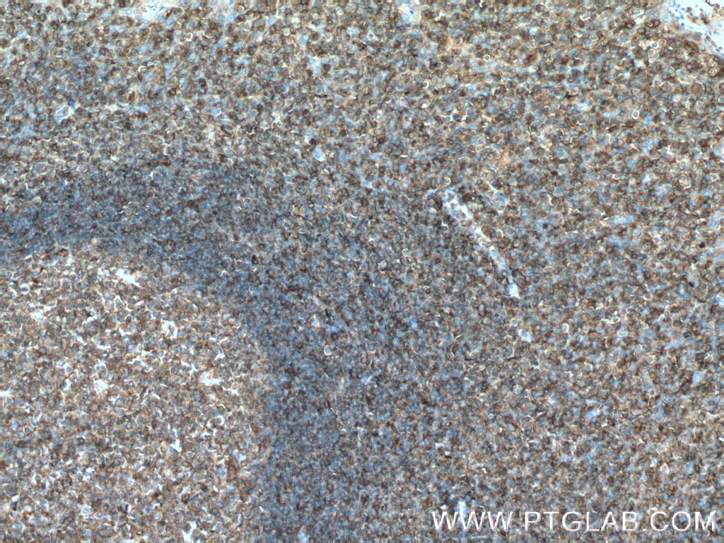 IHC staining of human tonsillitis using 66530-1-Ig