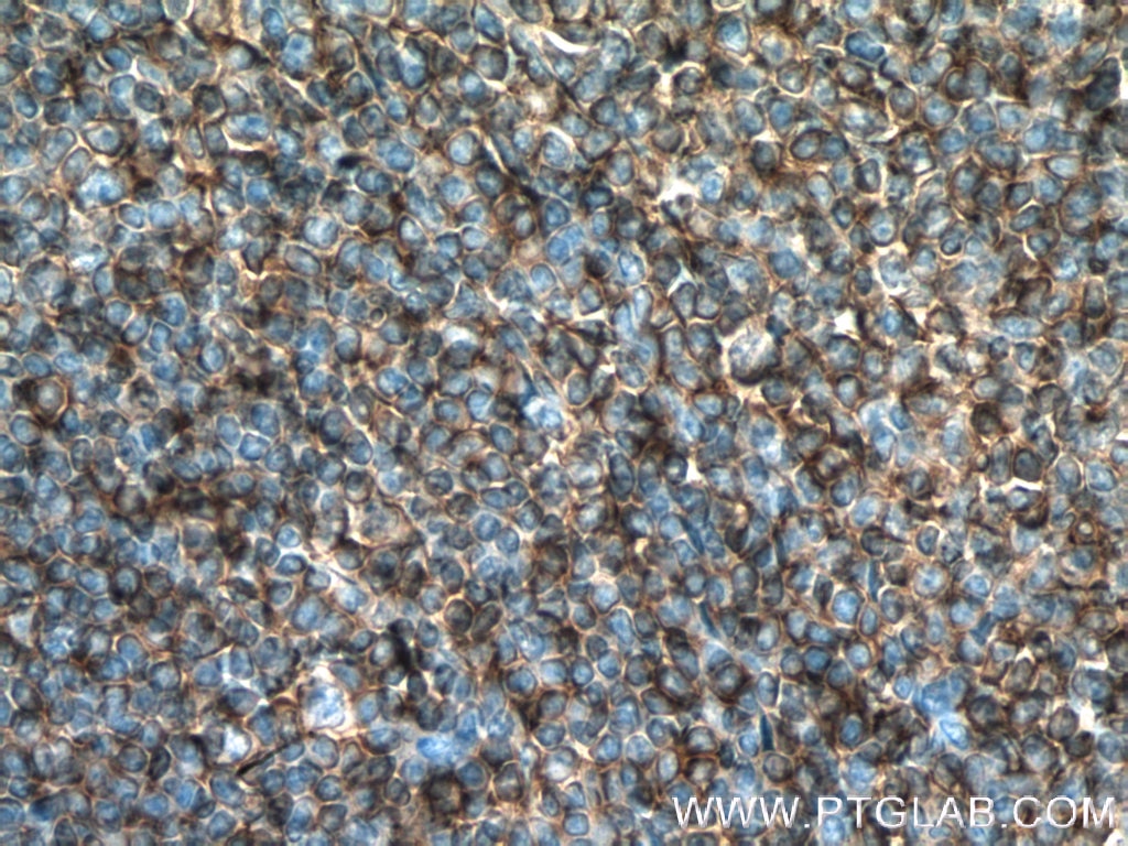 IHC staining of human tonsillitis using 66530-1-Ig