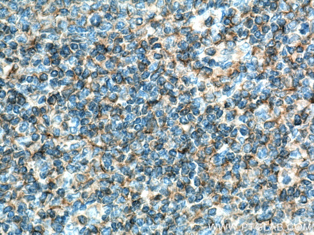 IHC staining of human tonsillitis using 14670-1-AP