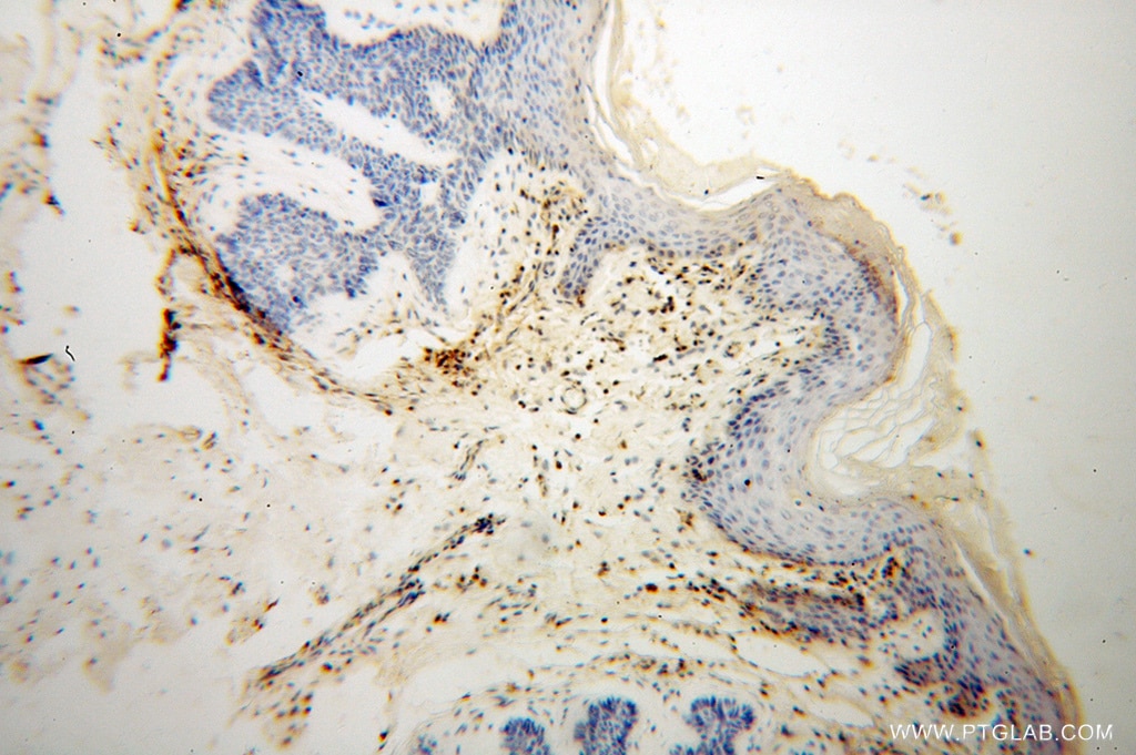 Immunohistochemistry (IHC) staining of human skin cancer tissue using HLA-F Polyclonal antibody (14670-1-AP)