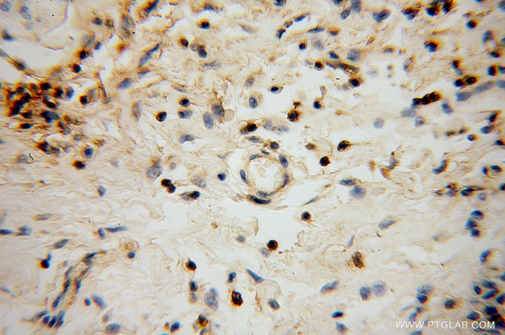 Immunohistochemistry (IHC) staining of human skin cancer tissue using HLA-F Polyclonal antibody (14670-1-AP)