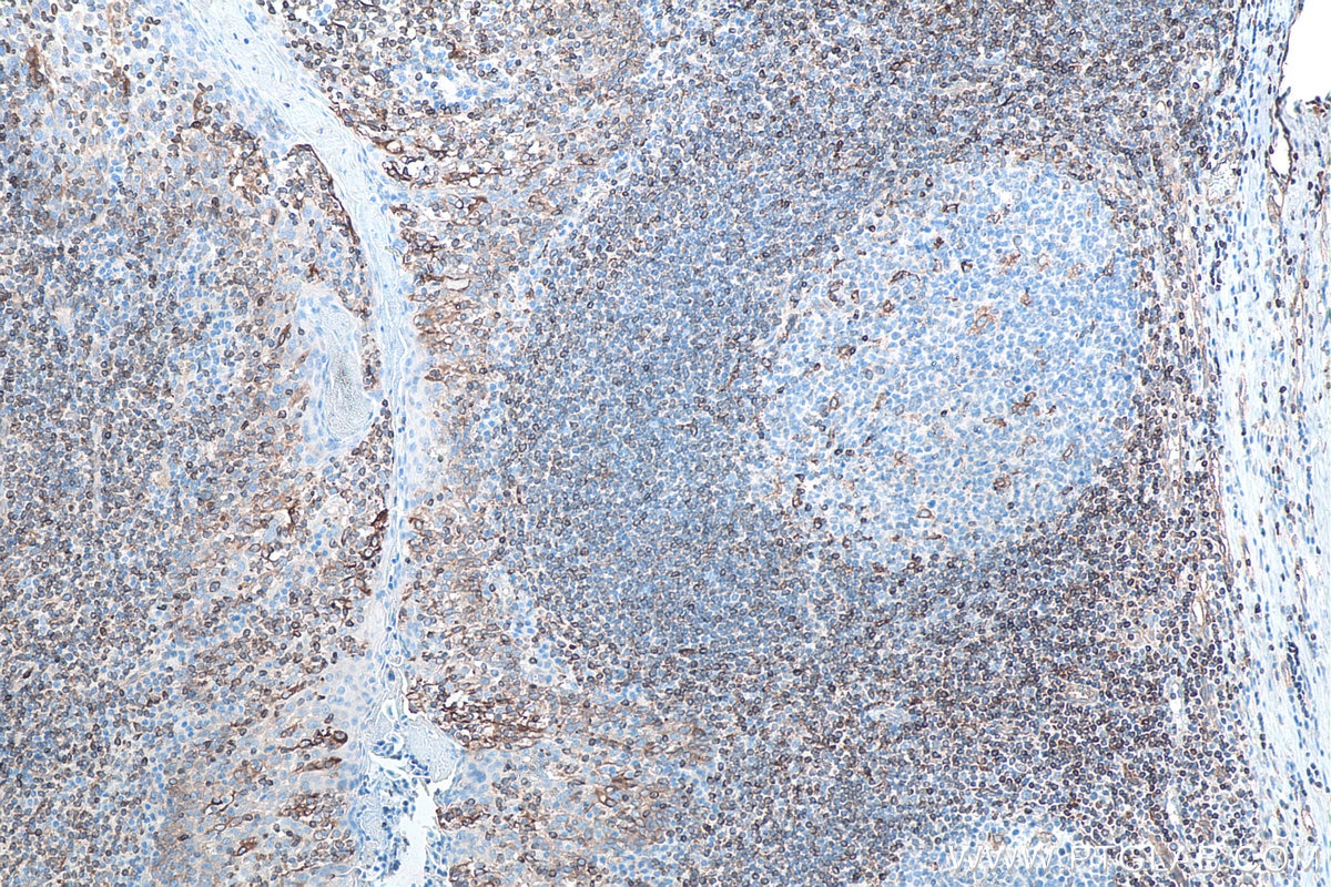 Immunohistochemistry (IHC) staining of human tonsillitis tissue using HLA-F Monoclonal antibody (66819-1-Ig)