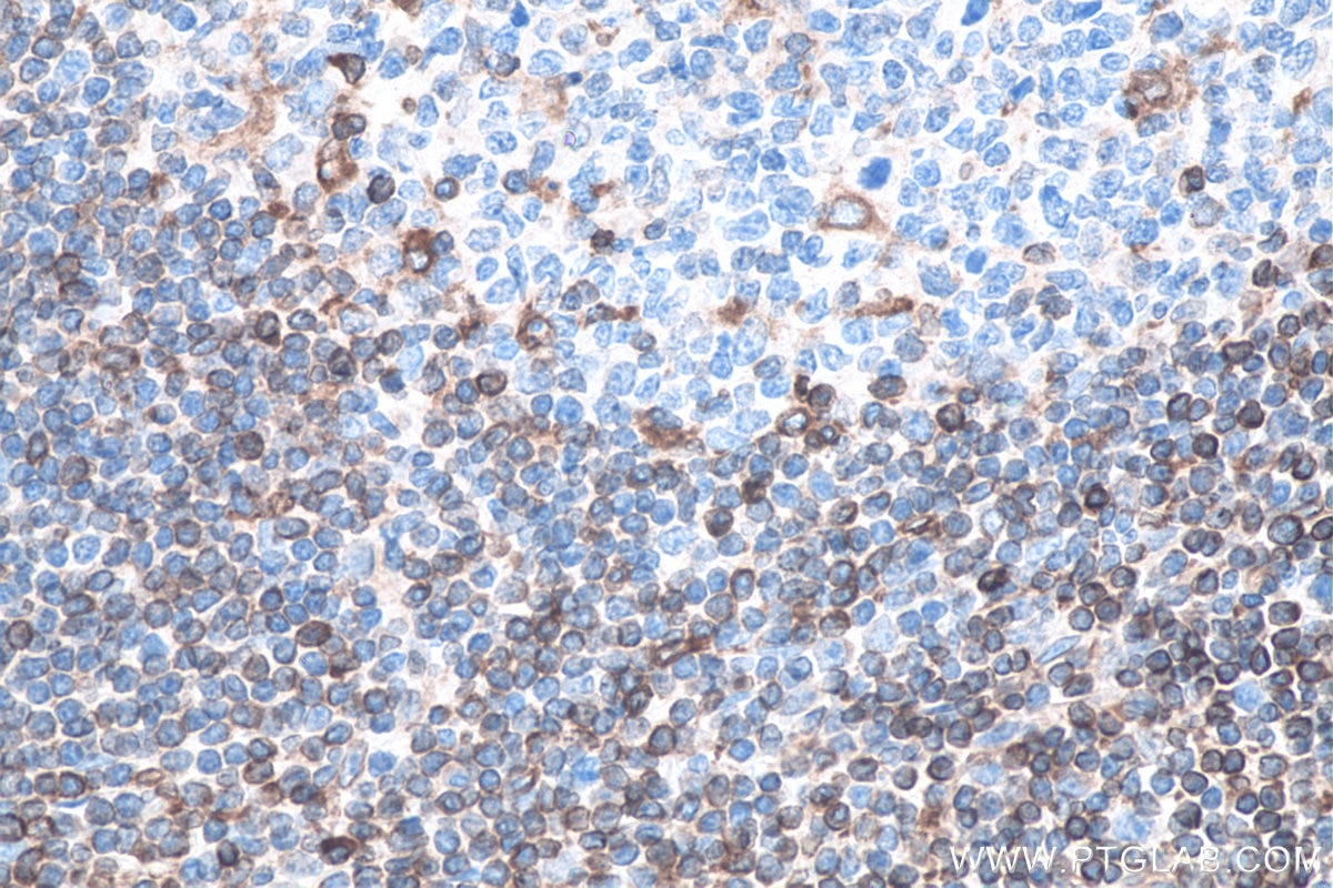 Immunohistochemistry (IHC) staining of human tonsillitis tissue using HLA-F Monoclonal antibody (66819-1-Ig)