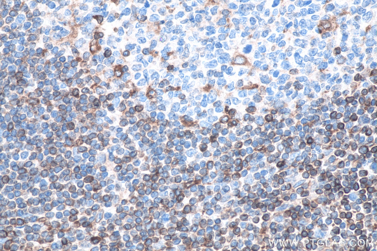 IHC staining of human tonsillitis using 66819-1-Ig