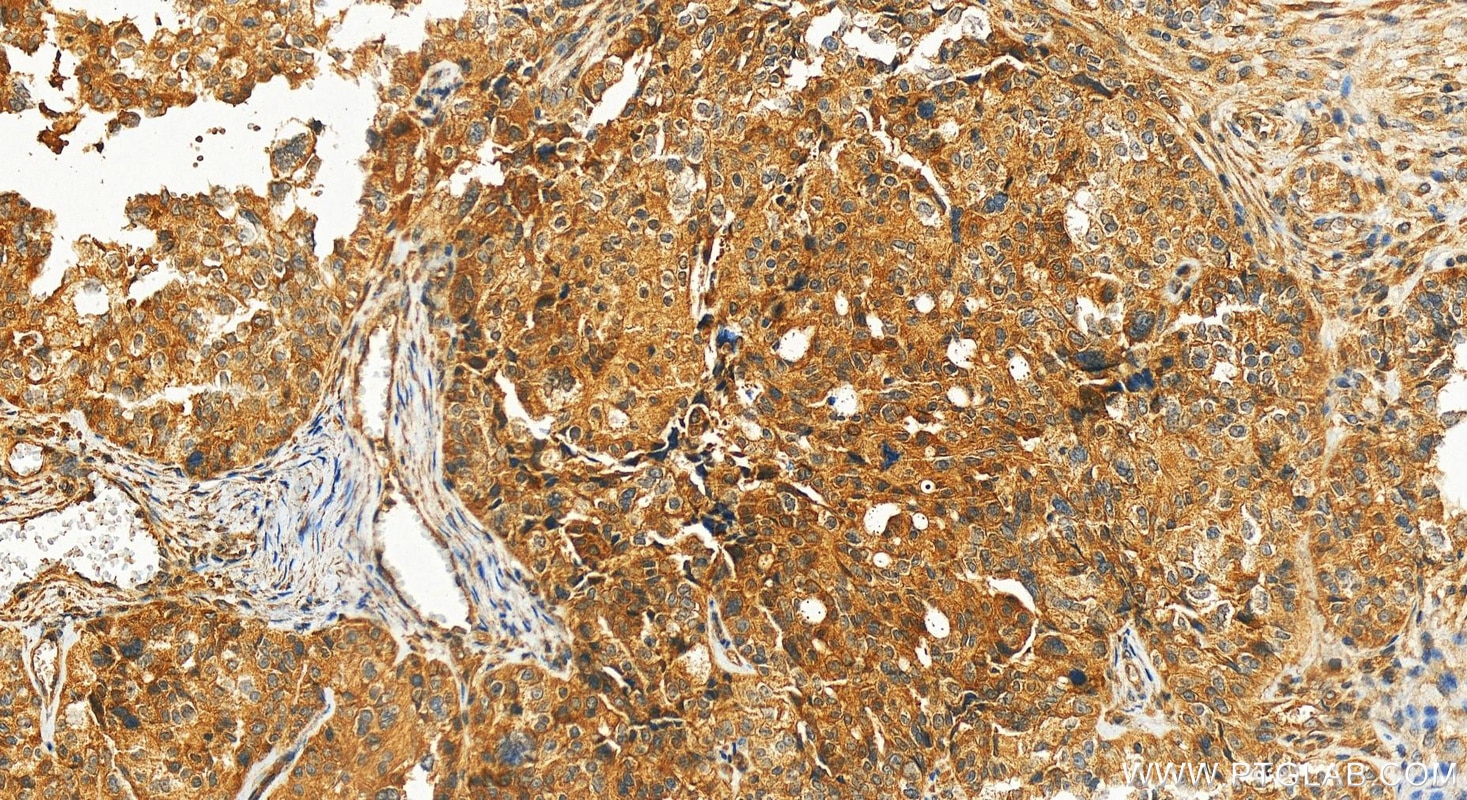 Immunohistochemistry (IHC) staining of human ovary cancer tissue using HLCS Polyclonal antibody (14046-1-AP)