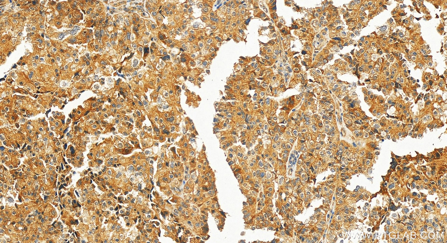 Immunohistochemistry (IHC) staining of human ovary cancer tissue using HLCS Polyclonal antibody (14046-1-AP)