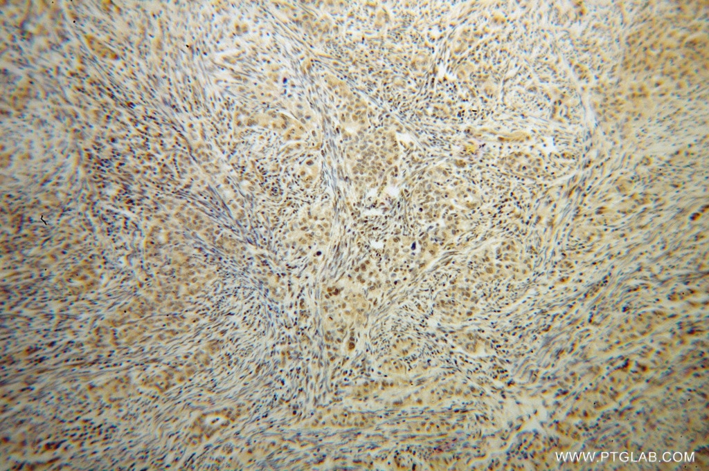 Immunohistochemistry (IHC) staining of human endometrial cancer tissue using HLX Polyclonal antibody (14336-1-AP)