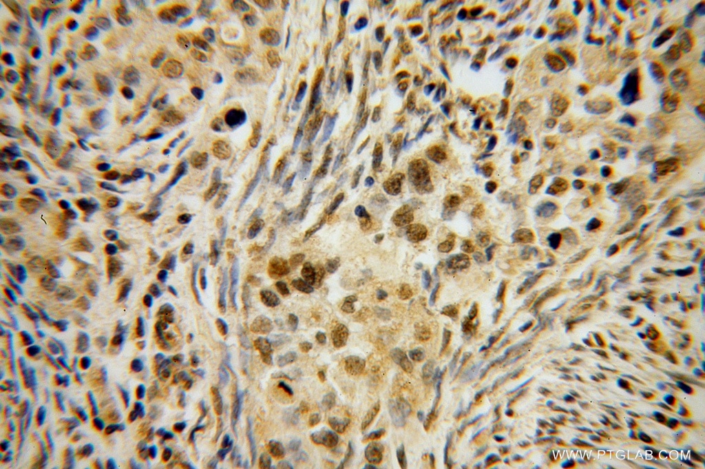 Immunohistochemistry (IHC) staining of human endometrial cancer tissue using HLX Polyclonal antibody (14336-1-AP)