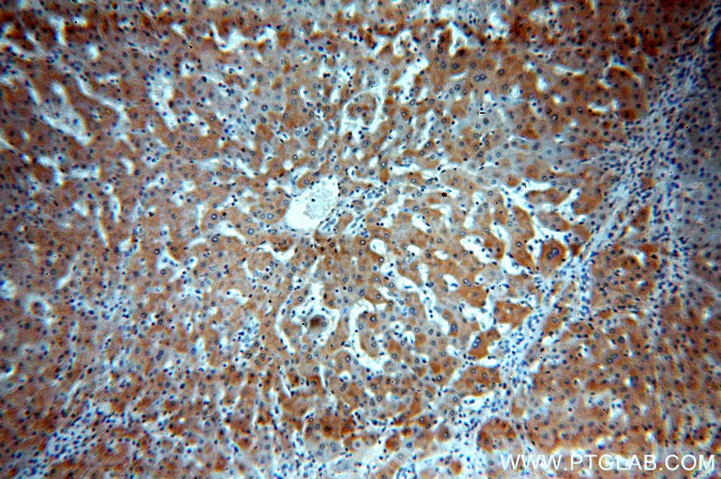 Immunohistochemistry (IHC) staining of human hepatocirrhosis tissue using SPP Polyclonal antibody (20416-1-AP)
