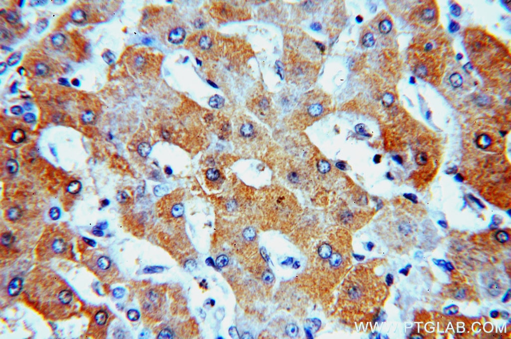 Immunohistochemistry (IHC) staining of human hepatocirrhosis tissue using SPP Polyclonal antibody (20416-1-AP)