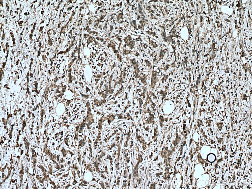 Immunohistochemistry (IHC) staining of human breast cancer tissue using HMBS Monoclonal antibody (67456-1-Ig)