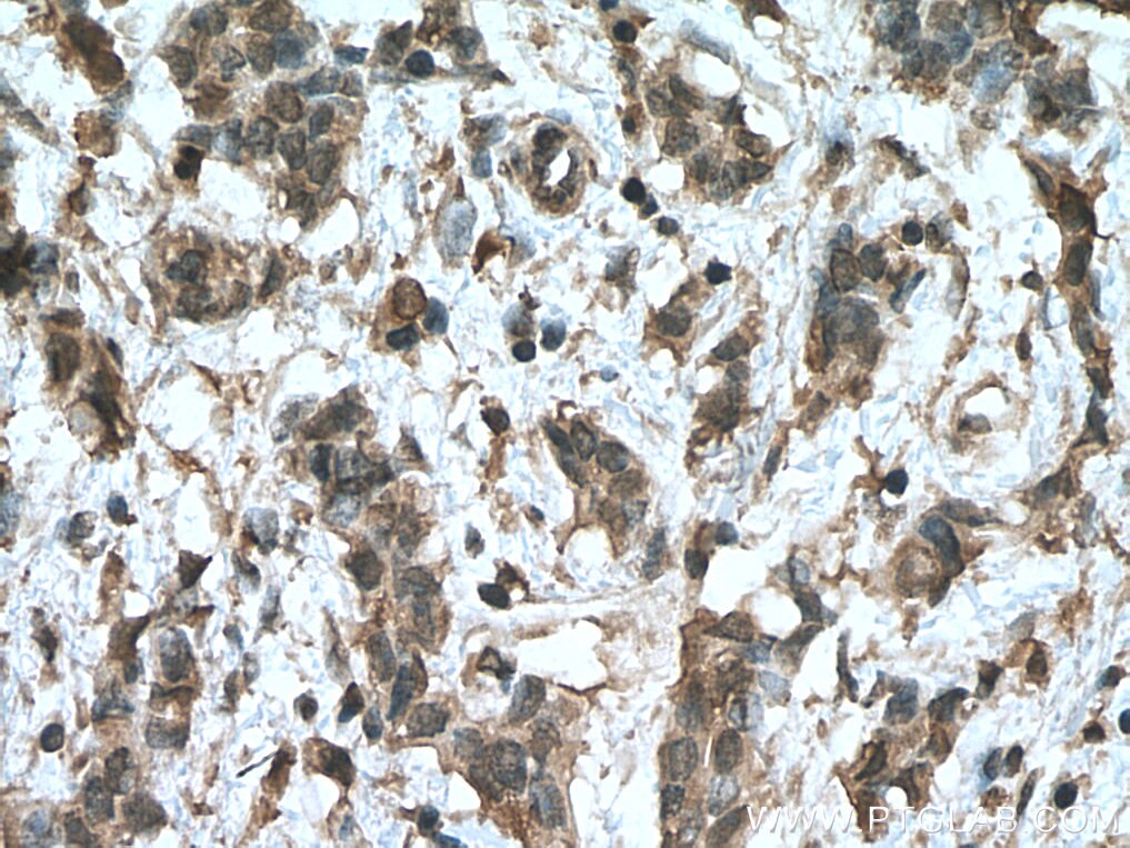 Immunohistochemistry (IHC) staining of human breast cancer tissue using HMBS Monoclonal antibody (67456-1-Ig)