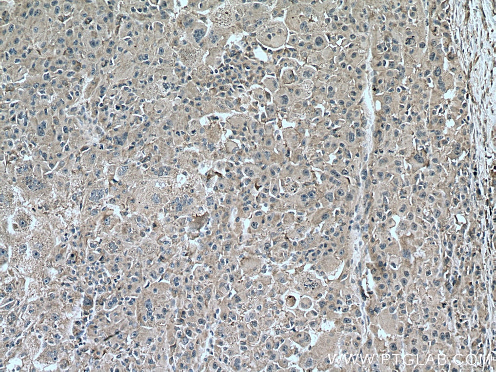 Immunohistochemistry (IHC) staining of human liver cancer tissue using HMBS Monoclonal antibody (67456-1-Ig)