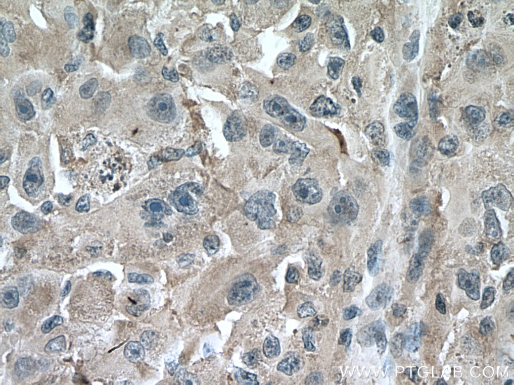IHC staining of human liver cancer using 67456-1-Ig
