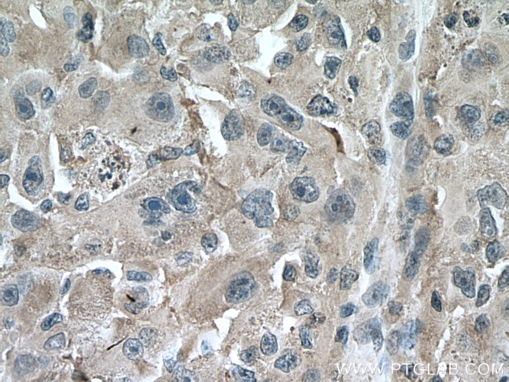 Immunohistochemistry (IHC) staining of human liver cancer tissue using HMBS Monoclonal antibody (67456-1-Ig)