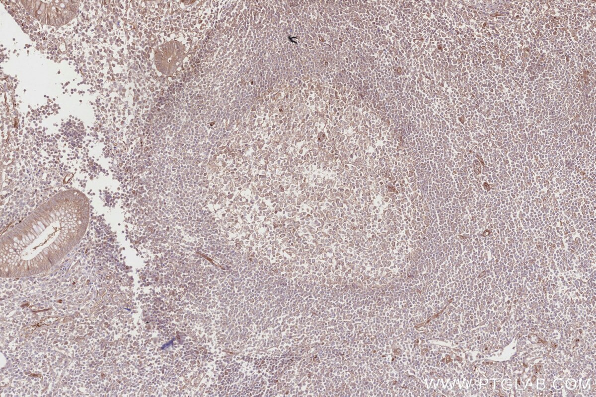 Immunohistochemistry (IHC) staining of human appendicitis tissue using HMCN1 Polyclonal antibody (18837-1-AP)