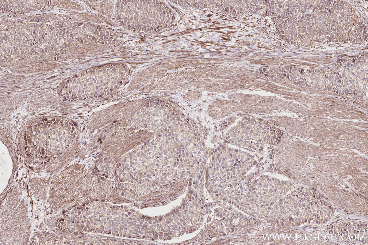 Immunohistochemistry (IHC) staining of human stomach cancer tissue using HMCN1 Polyclonal antibody (18837-1-AP)