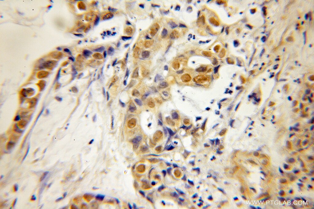 IHC staining of human pancreas cancer using 12085-2-AP