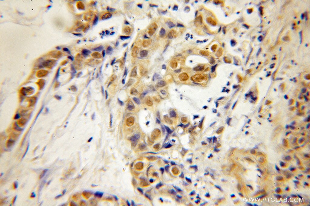 Immunohistochemistry (IHC) staining of human pancreas cancer tissue using HMG20A Polyclonal antibody (12085-2-AP)