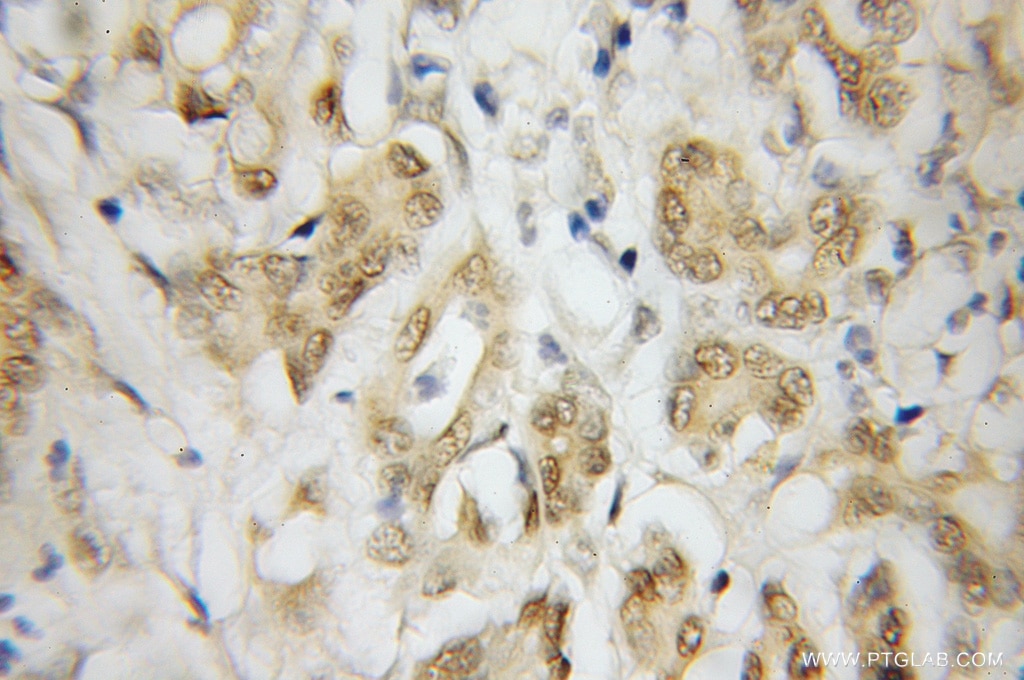 Immunohistochemistry (IHC) staining of human pancreas cancer tissue using HMG20A Polyclonal antibody (12085-2-AP)