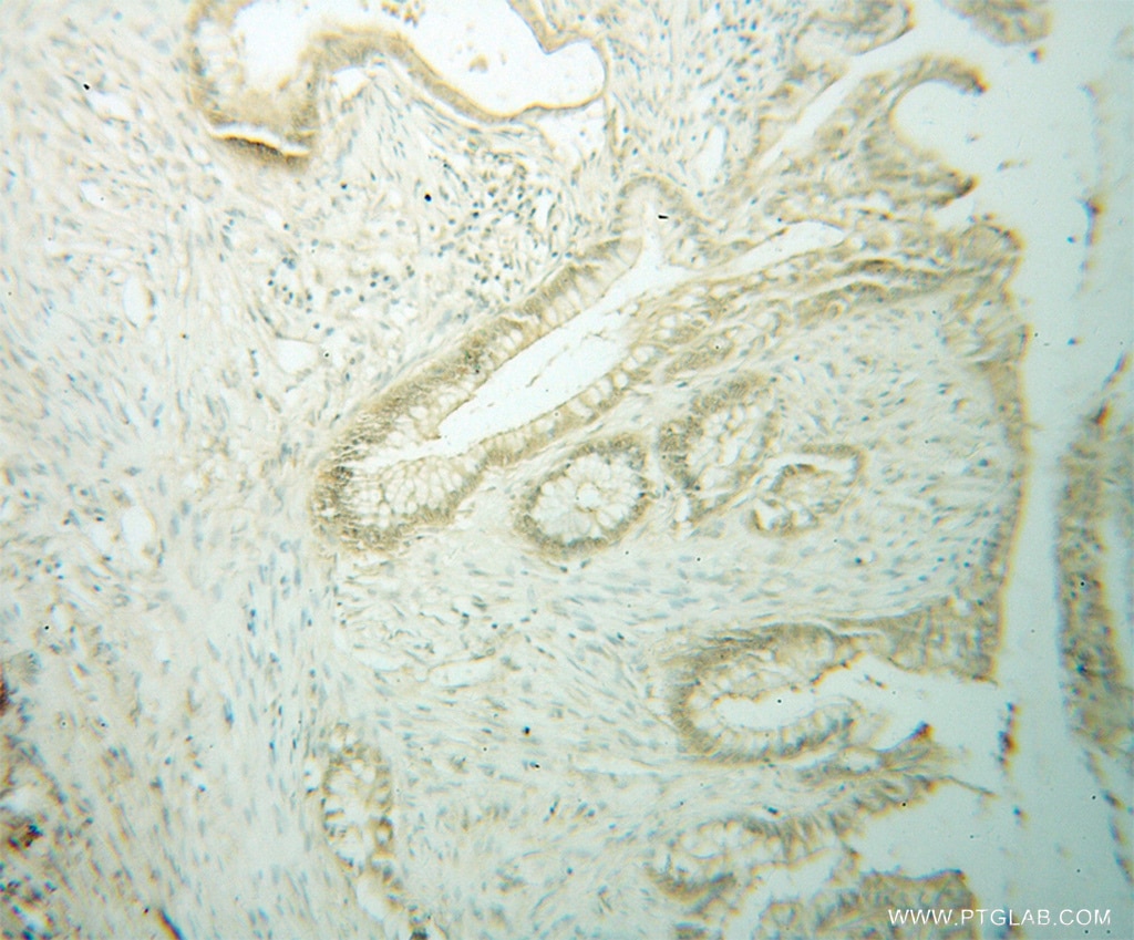 Immunohistochemistry (IHC) staining of human colon cancer tissue using HMG20B Polyclonal antibody (14582-1-AP)