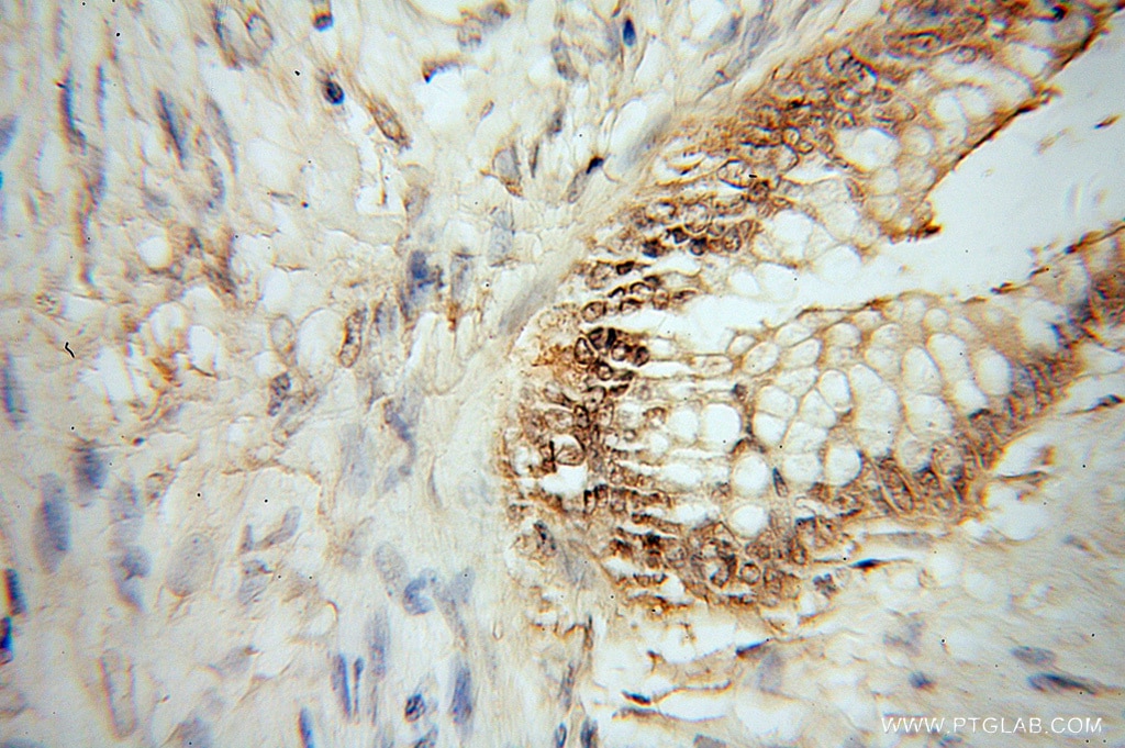Immunohistochemistry (IHC) staining of human colon cancer tissue using HMG20B Polyclonal antibody (14582-1-AP)