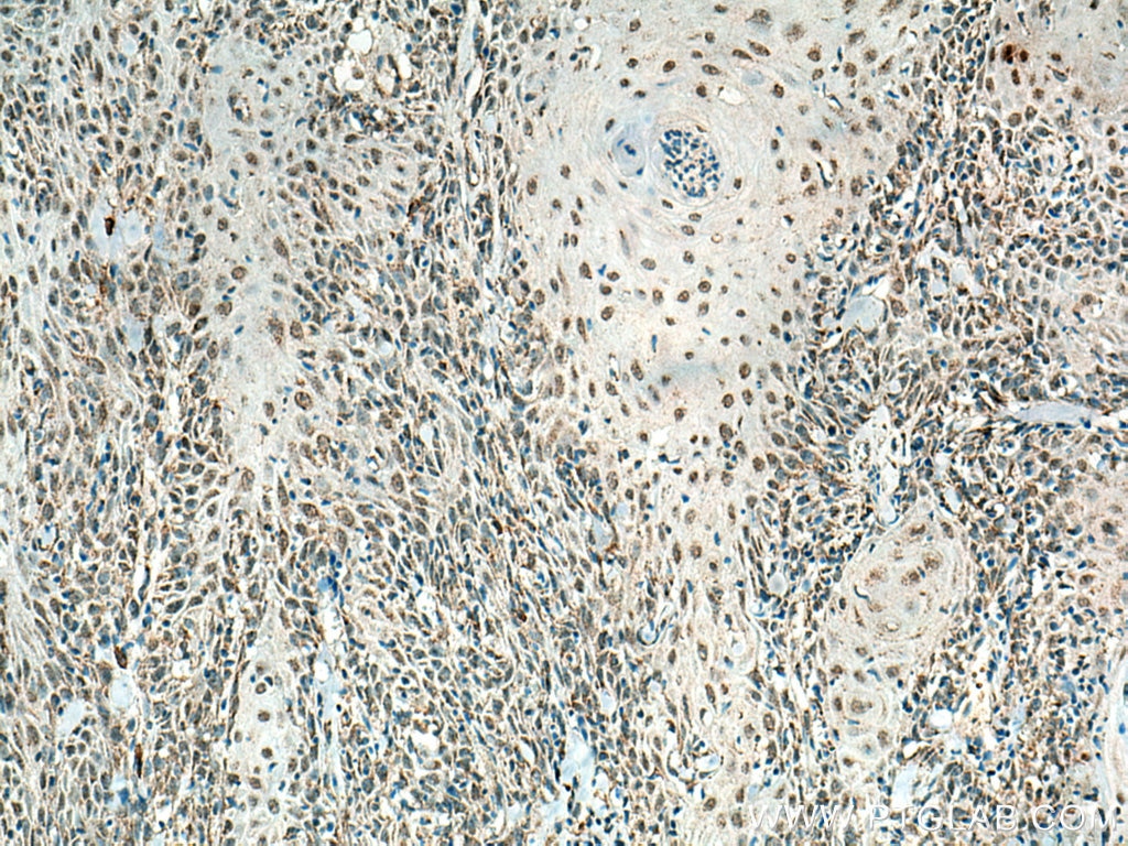 Immunohistochemistry (IHC) staining of human skin cancer tissue using HMG20B Monoclonal antibody (67354-1-Ig)