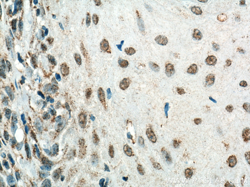 Immunohistochemistry (IHC) staining of human skin cancer tissue using HMG20B Monoclonal antibody (67354-1-Ig)
