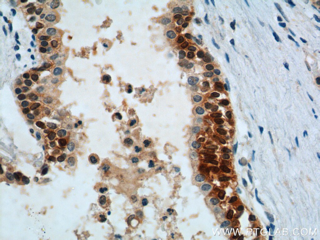 Immunohistochemistry (IHC) staining of human prostate cancer tissue using HMGA1 Polyclonal antibody (15398-1-AP)