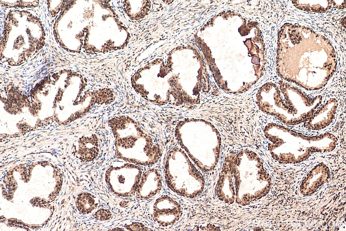 Immunohistochemistry (IHC) staining of human prostate cancer tissue using HMGA1 Polyclonal antibody (29895-1-AP)